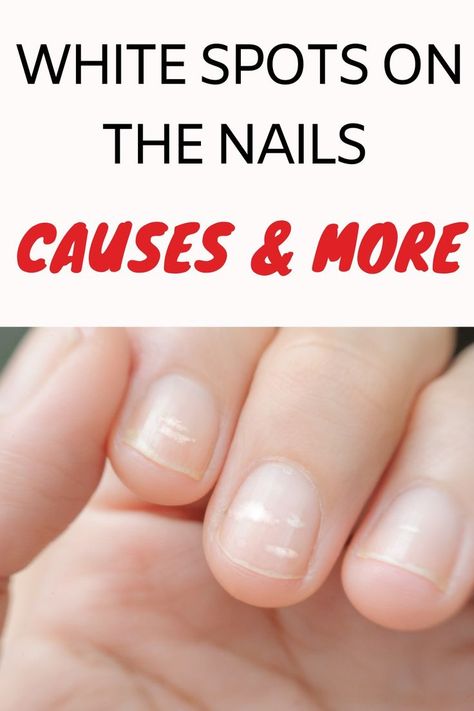 White Dots On Nails, White Spots On Fingernails, White Lines On Nails, White Marks On Nails, White Spots On Toenails, White Spots On Nails, Nail Spot, Nail Infection, Fungal Nail