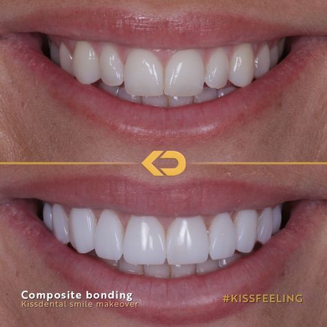 How incredible is this composite veneer makeover?! This patient was looking for a brighter more symmetrical smile. The Dr placed 10 composite edge bonds to complete the look. Book in for a FREE consultation at any of our clinics: 📍Manchester City centre 📍Flixton 📍Altrincham 📍Knutsford 📍Alderley Edge 📍Liverpool 📍Bramhall Head to kissdental.co.uk to get booked in