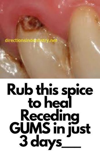 Tooth Scaling, Grow Back Receding Gums, Fix Teeth, Tooth Decay Remedies, Teeth Health, Oral Care Routine, Gum Care, Receding Gums, Teeth Care