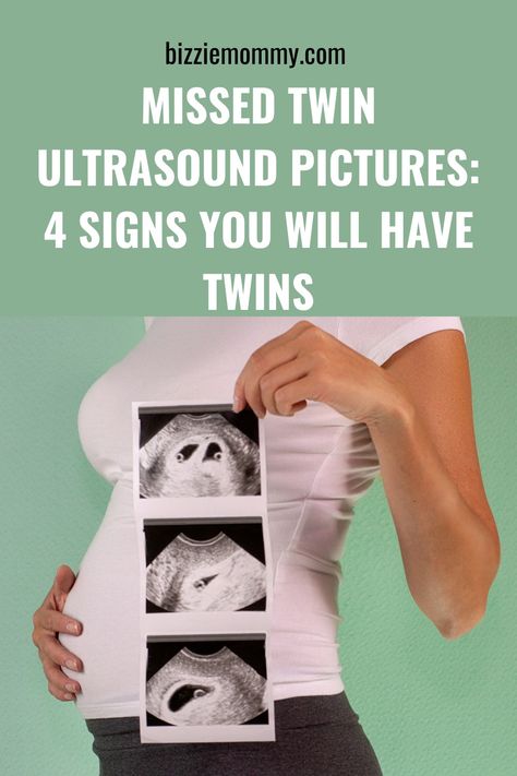 Missed Twin Ultrasound Pictures: 4 Signs You Will Have Twins 8weeks Pregnant Ultrasound, Twin Ultrasound Pictures, Twin Ultrasound, Twins Ultrasound, 6 Weeks Pregnant, Pregnancy Ultrasound, First Ultrasound, Ultrasound Tech, Ectopic Pregnancy