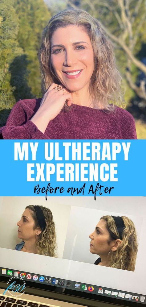 Read about my Ultherapy experience before and after. Ultherapy is the only FDA-cleared non-invasive treatments for lifting and tightening brow, neck and chin. #sponsored #ultherapy #antiaging #skincare #treatments Ultherapy Before And After Jowls, Neck Tightening Procedures, Neck Lift Before And After, Face Tightening Procedures, Ultherapy Before And After, Skin Treatments For Dark Spots, Home Facial Treatments, Neck Tightening, Anti Aging Neck