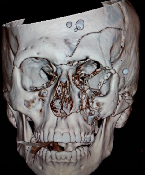 #State-of-the-art #multislice #ct can show facial #fractures in better detail. Facial Fractures, Computed Tomography, Diagnostic Imaging, Medical Imaging, Ct Scan, Medical Field, Radiology, Galaxy Wallpaper, Radios