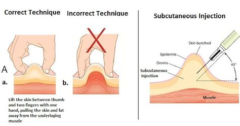 Subcutaneous injection Subcutaneous Injection Sites, Types Of Injection, Medical Terminology Study, Subcutaneous Injection, Nursing Skills, Midwifery Student, Medical Device Design, Subcutaneous Tissue, Tissue Types