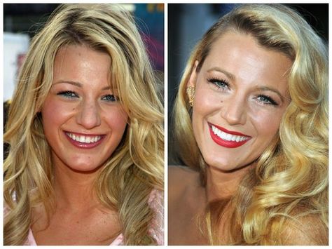 Blake Lively before and after porcelain veneers Celebrities With Veneers, Lip Fillers Shapes, Celebrity Teeth, Pretty Teeth, Celebrity Smiles, Dental Assisting, Veneers Teeth, Porcelain Veneers, Perfect Teeth