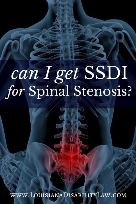 Narrowing Of The Spine, Stenosis Of The Spine, Stenosis Exercises, Spinal Degeneration, Spine Problems, Spinal Decompression, Spine Health, Nerve Pain Relief, Sciatic Nerve Pain