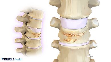 Osteoporosis Symptoms, Osteoporosis Exercises, Osteoporosis Prevention, Very Low Calorie Diet, Weight Bearing Exercises, Foods With Calcium, Spine Health, Collagen Supplements, Bone Density