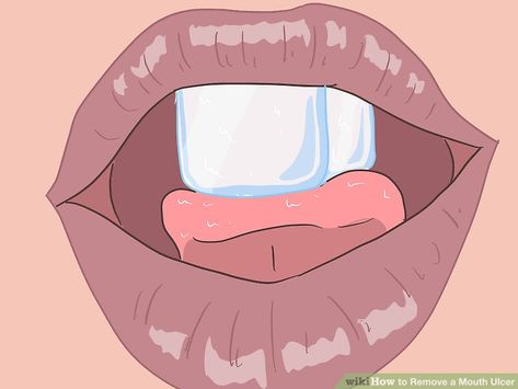 3 Ways to Remove a Mouth Ulcer - wikiHow Tongue Ulcer Remedies, Ulcer On Tongue, Mouth Blisters, Ulcer Remedies Mouth, Canker Sore Remedy, Mouth Ulcer, Tongue Sores, Get Rid Of Things, Natural Remedies For Migraines