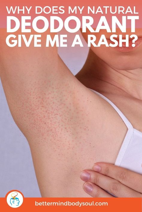 Switching to natural products like deodorants is a bit of a transition process. Especially since some can cause skin irritations and rashes. But it’s usually not the fault of the new natural product. There’s a number of different factors that come into play before landing on allergies. This article touches on all the points to look at when dealing with rashes form natural deodorants, so have a read and see what applies to you and what you can do about it.  #AllNatural  #organic Prickly Heat Rash, Deodorant Alternatives, Armpit Rash, Rashes Remedies, Rash Causes, Sweating Too Much, Underarm Deodorant, Prickly Heat, Deodorant Recipes