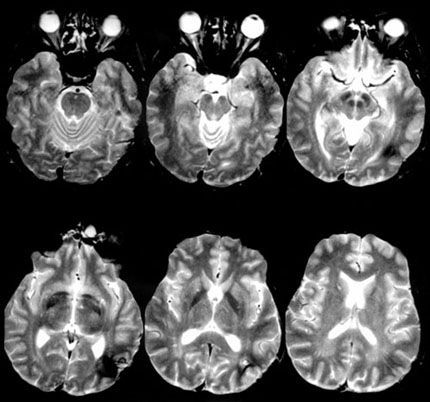 Author George P. Prigatano, PhD Division of Neurology, Barrow Neurological Institute, St. Joseph’s Hospital and Medical Center, Phoenix, Arizona Abstract Picks Disease, Brain Inflammation, Guillain Barre Syndrome, Brain Scan, Brain Surgery, Nerve Damage, Neurological Disorders, Brain Damage, Medical Research