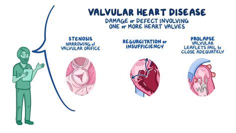 Valvular heart disease: Nursing: Video & Anatomy | Osmosis Valvular Disease, Cardiovascular Disease Nursing, Disease Processes Nursing, Acute Coronary Syndrome Nursing, Coronary Arteries Disease Nursing, Nursing Videos, Communicable Diseases Nursing, Heart Diseases, Heart Valves