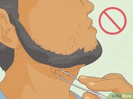 3 Ways to Treat Infected Ingrown Hair - wikiHow Infected Ingrown Hair, Treat Ingrown Hair, Ingrown Hair Remedies, Ingrown Hair Removal, Bump Hairstyles, Diy Beard, Prevent Ingrown Hairs, Homemade Facials, Step By Step Hairstyles