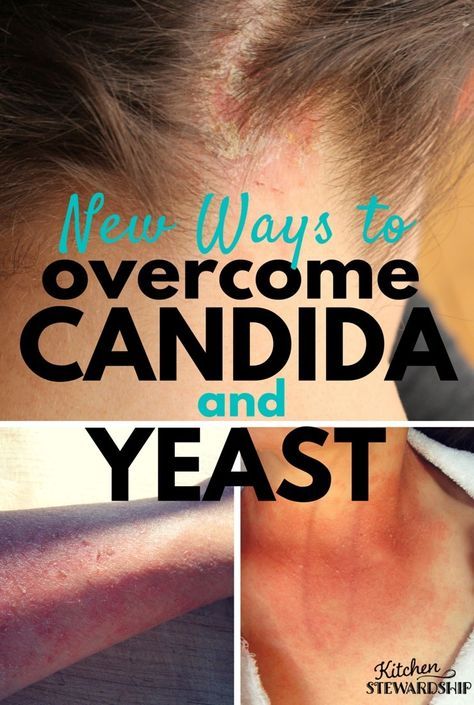 New Ways to Overcome Candida and Yeast - fermented foods to eat, will killing it with herbs help, and what foods to avoid - via Body Ecology Diet Candida Cleanse Diet, Body Ecology Diet, Candida Symptoms, Candida Yeast Infection, Yeast Overgrowth, Candida Diet Recipes, Candida Cleanse, Candida Overgrowth, Candida Yeast