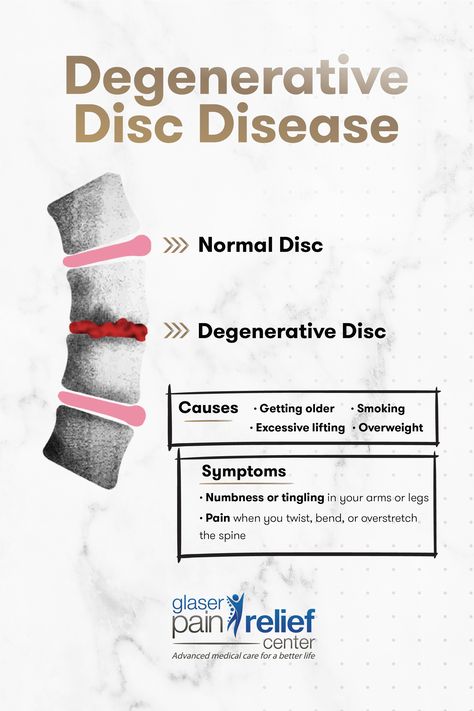 Most people have some degree of disc degeneration starting between the ages of 40 to 60. Not everyone will experience symptoms of pain at that point, however.  Here are the symptoms of degenerative disc disease to look out for☝ Degenerate Disc Disease, Spinal Anatomy, Spinal Fusion Surgery, Spine Problems, Degenerative Disease, Spine Health, Leg Pain, Bone Health, Health And Beauty Tips