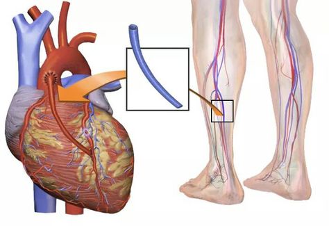 Thoracic CABG surgery Open Heart Surgery, Bypass Surgery, Nursing School Notes, Coronary Arteries, Heart Surgery, Medical Tourism, Heart Health, Surgery, Nursing