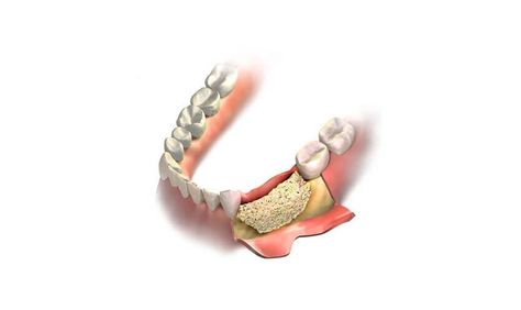 Suffering from bone loss but want to get your Implants for a beautiful smile transformation? Then visit our office, in Cincinnati, OH for Bone Grafting! Bone Grafting Teeth, Smile Transformation, Bone Grafting, Teeth Implants, Bone Loss, Dental Implants, Dental Care, Beautiful Smile, Cincinnati