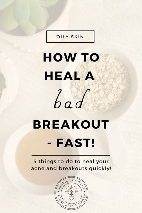 Want to get rid of breakouts quickly? Do these 5 things every time you are having a breakout to heal it super quick! Breakout Remedies, Forehead Acne, Bad Acne, Get Rid Of Acne, Rid Of Acne, Natural Acne Remedies, Natural Acne, Cystic Acne, Acne Spots