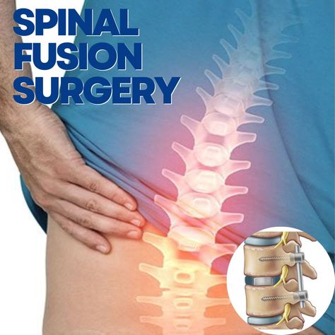 spinal fusion surgery is a significant medical intervention that offers hope and relief to individuals suffering from certain spinal conditions and injuries. #spinalfusionsurgery #spinalsurgery #successfulsurgery #spinesurgery Spinal Fusion Surgery, Spinal Fusion, Disk Herniation, Ray Of Hope, Spinal Surgery, Bulging Disc, Neck Surgery, Spine Surgery, Leg Pain