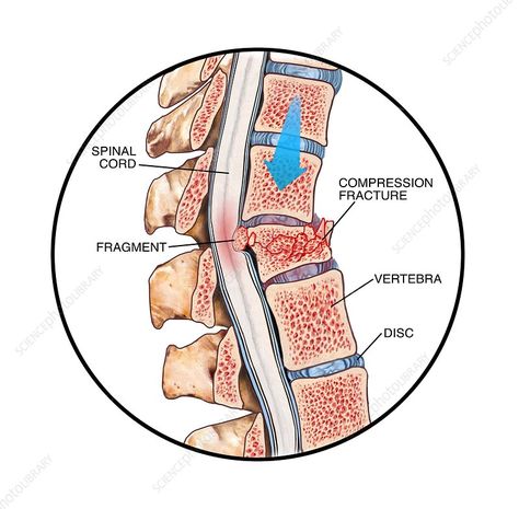 Spinal compression fracture Spinal Cord Anatomy, Human Body Vocabulary, Nerve Anatomy, My Knee Hurts, Knee Pain Exercises, Spinal Surgery, Spine Health, Medicine Student, Kinesiology Taping