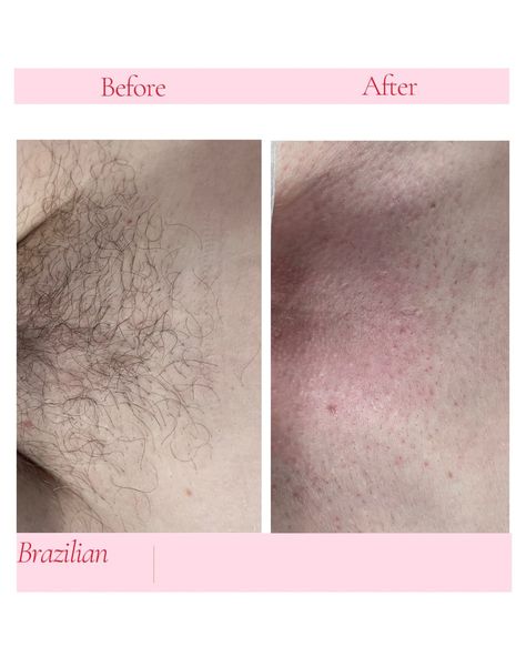 Natural facial hair removal