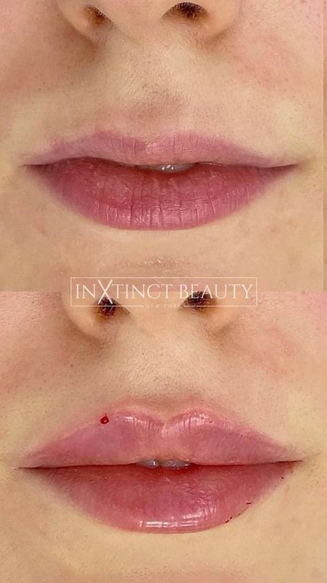 https://pin.it/7ueO5YwJy Pillow Lips Filler, Lip Filler Inspo Heart Shape, Bow Shaped Lip Filler, Keyhole Lip Fillers, Upper Lip Filler, Light Lip Filler, Lip Filler On Small Lips, Russian Lips Filler Before And After, Top Lip Filler