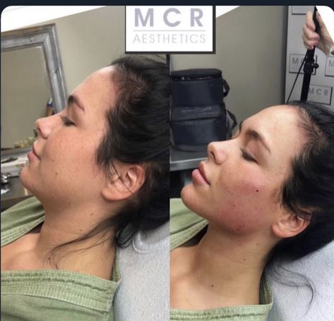 Face Injections, Face Plastic Surgery, Nose Fillers, Chin Filler, Rhinoplasty Nose Jobs, Lips Inspiration, Face Fillers, Botox Lips, Cheek Fillers