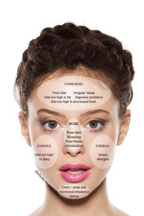 Acne Face Mapping, Acne Face Map, Hormonal Acne Diet, Face Map, Face Mapping Acne, Acne Diet, Blind Pimple, Pimples Under The Skin, Bad Acne