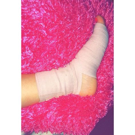 Sprained my foot... Not fun Leg Plaster Snapchat, Leg Injury Snapchat Streaks, Broken Leg Snapchat Story, Leg Fracture Snap, Leg Fracture Snapchat, Sprained Ankle Snapchat, Leg Injury Fake Story, Broke Leg Snapchat, Fracture Photo