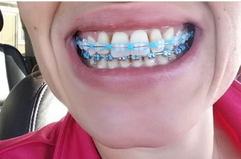 Power Chain Braces Colors, Clear Braces With Color Bands, Braces Colors Ideas Dark Skin, Chain Braces, Power Chains, Braces Colours, Power Chain Braces, Braces Ideas, Braces Retainer