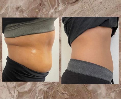 Body Cavitation Body Cavitation, Skincare Content, Skin Tightening Treatments, Content Ideas, Body Sculpting, Body Contouring, Skin Tightening, Body Fit, Curly Hair Styles