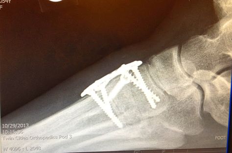 After LisFranc Surgery Lisfranc Injury, Broken Foot, Ankle Surgery, Foot Exercises, Foot Injury, Surgery Recovery, Surgery, Medical