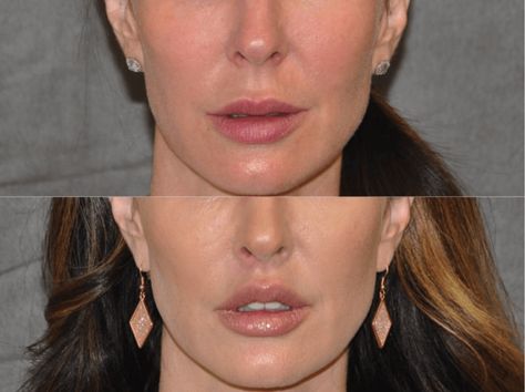 The Lip Lift is a cosmetic surgery that enhances the look of the entire face. Our Doctors are leaders in this field, providing amazing aesthetic results. Lip Lift Surgery, Upper Lip Lift, Lip Surgery, Lip Lift, Amazing Aesthetic, Facial Bones, Facial Fillers, Eyebrow Grooming, Celebrity Plastic Surgery