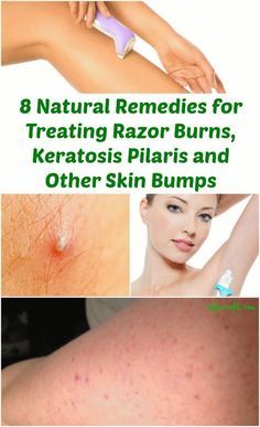 8 Natural Remedies for Treating Razor Burns, Keratosis Pilaris and Other Skin Bumps Skin Bumps, Keratosis Pilaris, Razor Burns, Makeup Tricks, Beauty Remedies, Skin Remedies, Homemade Beauty Products, Health And Beauty Tips, Beauty Treatments