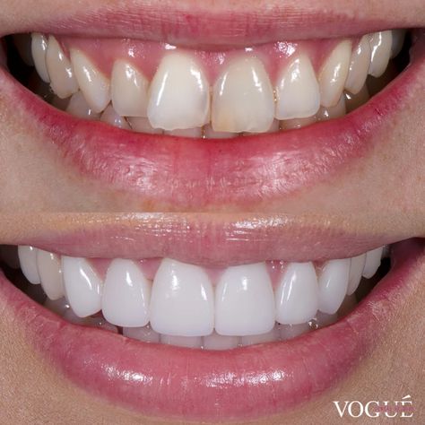 Veneer Teeth, Teeth Makeover, Natural Veneers, Pretty Teeth, Veneers Teeth, Beautiful Teeth, Porcelain Veneers, Perfect Teeth, Teeth Implants