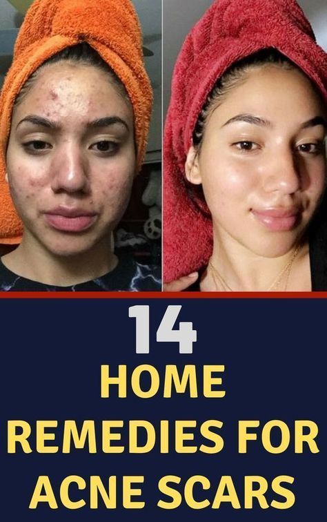 Acne Remedy, Acne Scar Remedies, Scar Remedies, Remedies For Acne, Acne Overnight, Acne Skincare Routine, Natural Acne, Home Remedies For Acne, Baking Soda Shampoo