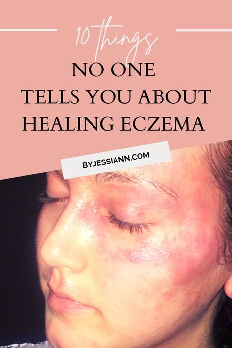 10 Steps to Getting Eczema Under Control - Skincare for Dry Skin