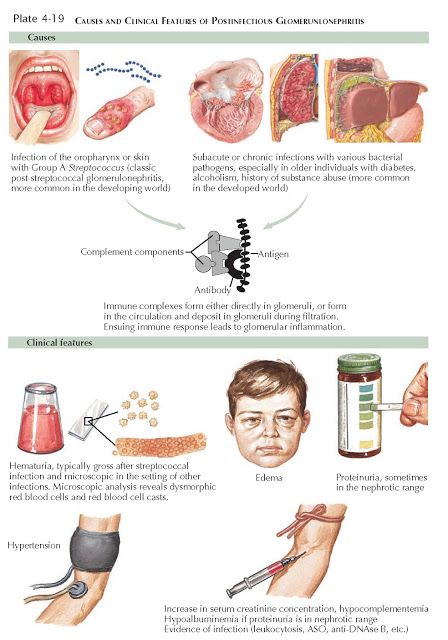 POSTINFECTIOUS  GLOMERULONEPHRITIS   Postinfectious glomerulonephritis (PIGN) is a syndrome of glomerular injury that occurs as a result of ... Nephritic Syndrome, Kidney Biopsy, Nephrotic Syndrome, Diet Schedule, Urinary System, Throat Infection, Cramps Relief, Healthy Substitutions, Med Surg