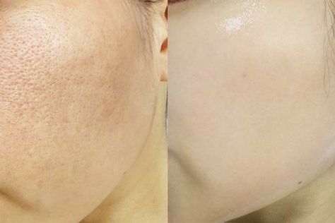 Micronidelling Face, Plasma Facial, Facial Before And After, Skin Poster, Skin Facts, Face Pores, Best Acne Products, Beauty Tips For Face, Healthy Skin Tips