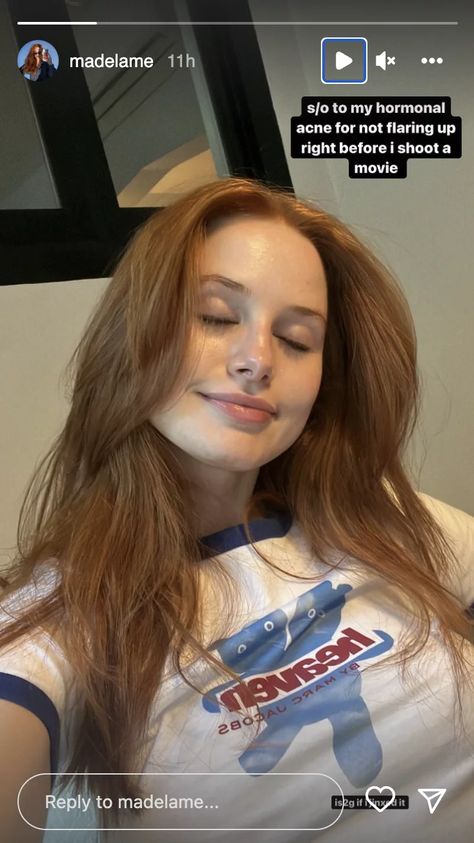 Madelaine Petsch Hilariously Thanks Her Acne on Instagram | POPSUGAR Beauty Riverdale Cheryl, Cherry Baby, Hormonal Acne, Madelaine Petsch, Cheryl Blossom, Art Life, Emma Roberts, Emma Stone, Ginger Hair