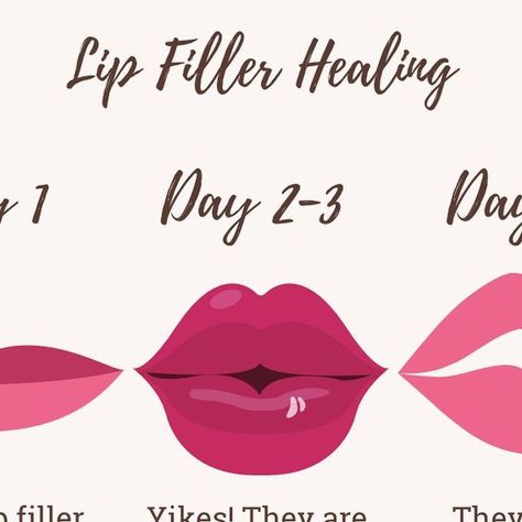 Demetria Whisenhunt on Instagram: "The healing phases of lip filler. It can take up to 2 weeks for your lips to fully heal after having injections. 💉 Days 1-3: Most intense swelling and bruising Days 4-7: Still swollen and possibly bruised but not as bad (most people love the lip swell) Days 8-13: They seem perfect! Most lumps/ bumps have gone away and bruising subsides. Days 14+: I love my lips 🥰 OR I need more filler 💋 This amazing patient allowed me to use her Befores and Afters to demonstrate the healing process! I used one full syringe of Juvederm Ultra to enhance her already luscious lips by emphasizing more on her bottom lip, creating a pouty lip shape." Lip Filler Gone Wrong, Lip Fillers Healing Process, Healed Lip Filler, Bruising After Lip Filler, Lip Filler Shape Ideas Pouty, Lip Filler Half Syringe, Bottom Lip Filler, Lip Filler Swelling Day By Day, Lip Filler Natural Look