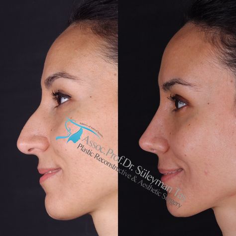 Ear Surgery Before And After, Long Nose Rhinoplasty Before And After, Rhinoplasty Results, Nose Plastic Surgery Before After, Nose Job Natural, Rynoplasty Surgery, Nose Surgery Before And After, Nose Tip Surgery Before After, Nose Job Before And After Rhinoplasty