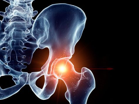 8 Steps You Should Take After a Hip Fracture - SilverSneakers Bone Healing Foods, Bone Healing, Hip Fracture, Bed Sores, Blood Pressure Medications, Strengthen Core, Help Yourself, When You Were Young, Hip Pain