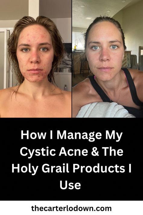 Find out how I manage my cystic acne and what products I use to keep acne at bay. #cysticacnetreatment #acneproducts #cysticacne #makeupforacneproneskin #makeupforoilyproneskin #cleanacneproducts #skincare Skincare For Cystic Acne, Cystic Acne Routine, Skin Care Routine For Cystic Acne, How To Get Rid Of Cystic Acne, Lip Acne, Spironolactone Before And After, Neck Acne Causes, Best Skin Care For Acne, Doxycycline For Acne Before And After