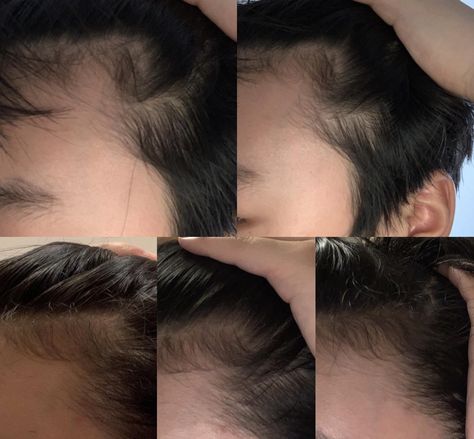 Does this look like its getting better? The top one was taken 2 months ago and the three bottom ones were recent. Im 14 and it looks like a receding hairline in my opinion because of the rounded edge of my hairline and the way it slightly curves upwards to the top on the top left corner picture Round Hairline, Widows Peak, Widow's Peak, Receding Hairline, Taken 2, Getting Better, My Opinions, 2 Months, Behind Ear Tattoo