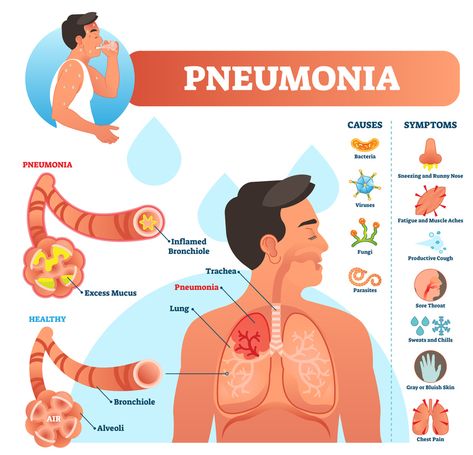 Pneumonia | MedicTests Mycoplasma Pneumonia, Pneumonia Remedies, Pneumonia Causes, Pneumonia Symptoms, Home Remedies For Bronchitis, Productive Cough, Streptococcus Pneumoniae, Natural Remedies For Migraines, Lung Infection