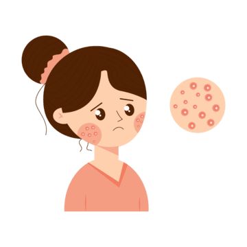 Acne Animation, Skin Care Cartoon, Acne Images, Acne Drawing, Acne Illustration, Skincare Icon, Jawline Acne, Back Acne Remedies, Blind Pimple