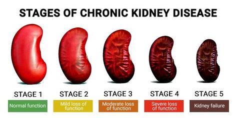 Chronic kidney disease is a critical condition that means lasting damage to the kidneys that cannot be reversed. It can turn life-threatening if the damage to your kidneys is grave, and they may even stop working. It can reduce your life expectancy and also affect your quality of life. Consult experienced and board-certified nephrologists at the Century Medical and Dental Center to get expert advice if you are at high risk of kidney failure or suspect something wrong. Chronic Kidney, Dental Center, Medical Dental, Life Expectancy, High Risk, Stop Working, Quality Of Life, Health Education, Gravity