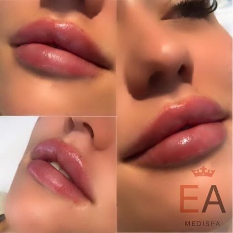 Elite Aesthetics, Lip Surgery, Model Beauty Secrets, Heart Shaped Lips, Lips Inspiration, Pretty Pregnant, Lip Filler, Facial Rejuvenation, Full Lips