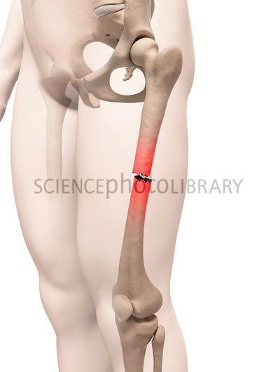 Femur Fracture, Gastrocnemius Muscle, Femur Bone, Types Of Bones, Anatomy Bones, Complementary Medicine, Bone Fracture, Alternative Treatments, Medical Illustration