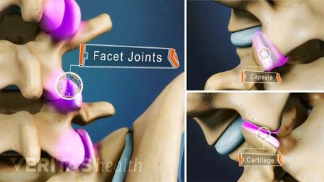 The facet joints in the lower back are frequently subject to large amounts of compressive, shear, and axial loading. These joints can become painful from degeneration, trauma, overuse, and posture-related problems. Back Cracking, Nerve Anatomy, Cauda Equina, Cover Wrinkles, Causes Of Back Pain, Lower Back Pain Exercises, Anatomy Tutorial, Spine Health, Sciatica Pain