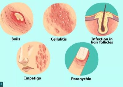 Molluscum Contagiosum, What Is Skin, Streptococcus Pneumoniae, Skin Anatomy, Fungal Infection Skin, Human Body Organs, Type Of Skin, Types Of Skin, Natural Antibiotics